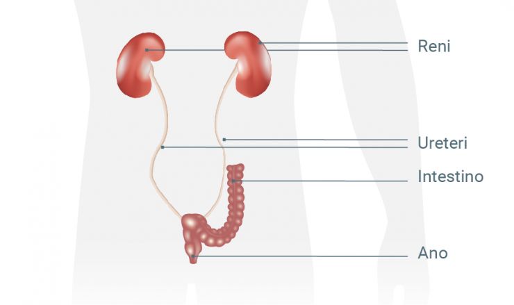Impianto uretero-intestinale: l’uretere e un tratto chiuso di intestino retto costituiscono la vescica sostitutiva