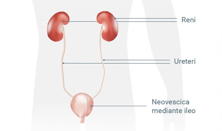 Neovescica: un tratto di intestino tenue o crasso chiuso sostituisce la vescica