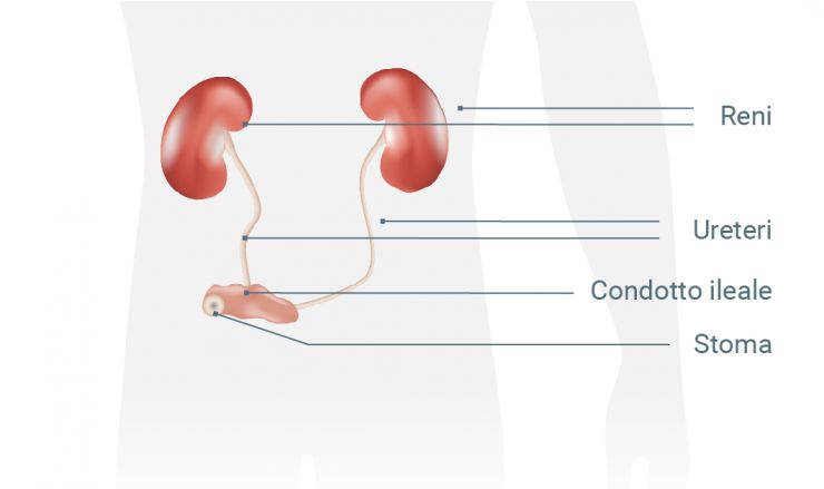 Urostomia: una sorta di canale di scorrimento convoglia l’urina in una stomia sulla parete addominale