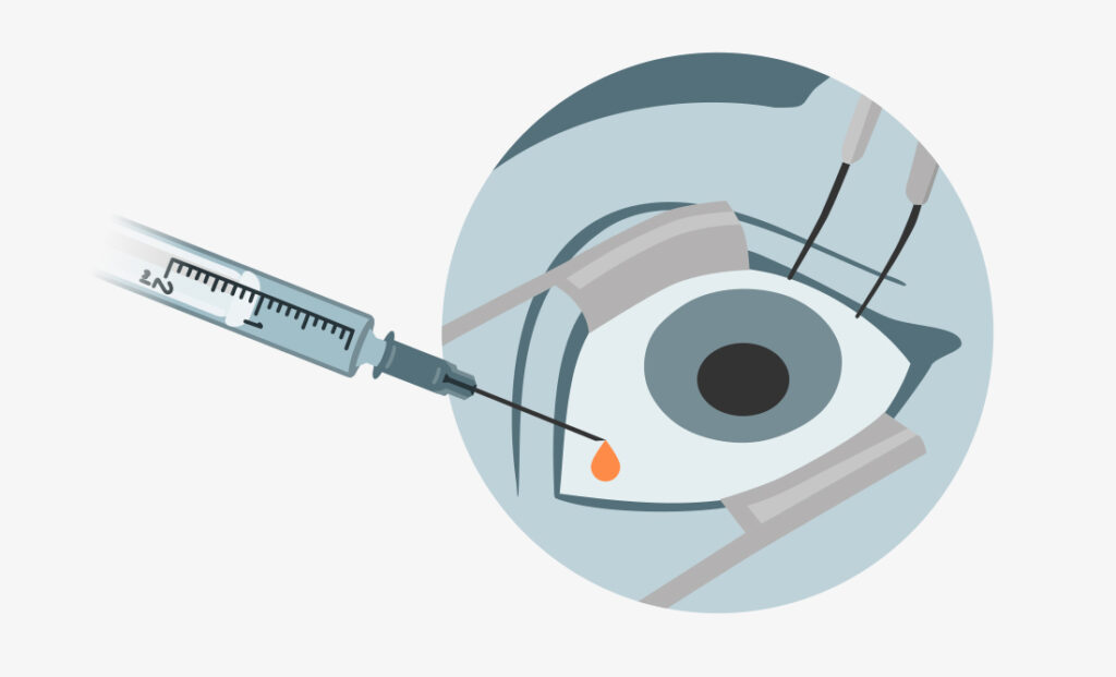 Illustration einer medizinischen Augeneingabe mit einer Spritze, die ein Medikament als Tropfen in das Auge appliziert