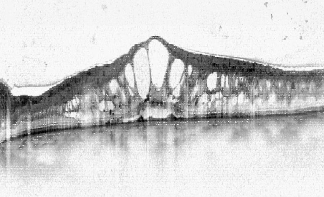 Querschnittsaufnahme der Netzhaut mit einem ausgeprägten Makulaödem, sichtbar durch dunkle, blasenartige Flüssigkeitsansammlungen und Verdickungen der Gewebeschichten.