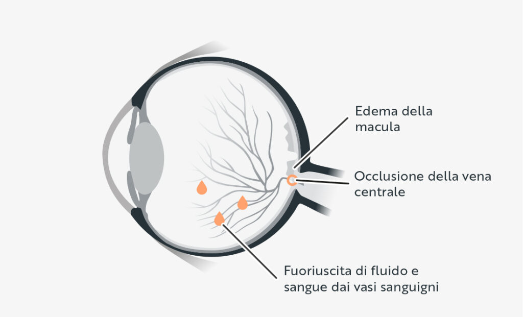 Schema di un occhio che mostra l'occlusione della vena centrale, l'edema della macula e la fuoriuscita di fluido e sangue dai vasi sanguigni