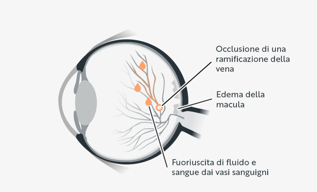 Schema di un occhio che mostra l'occlusione di una ramificazione della vena, l'edema della macula e la fuoriuscita di fluido e sangue dai vasi sanguigni.